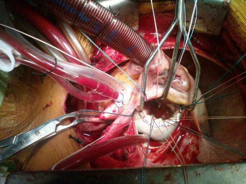 Photo d'une opération à coeur ouvert